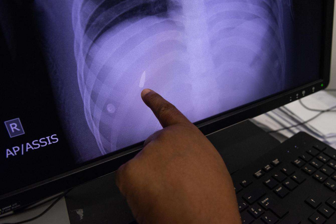 At MSF's Tabarre trauma center, an MRI shows a large caliber bullet lodged in a patient's rib cage. Stray bullets, mostly large caliber, are becoming a growing problem in Port-au-Prince.