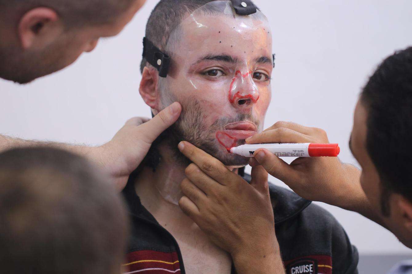 MSF medical teams make a 3d-printed prosthetic face mask for a young man in Gaza.