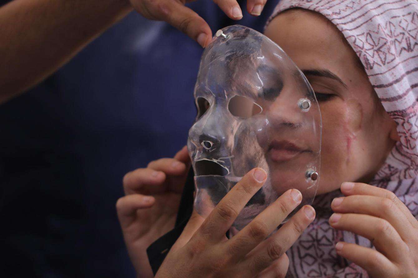 MSF medical teams in Gaza fit a clear prosthetic face mask for a young woman with facial scars.