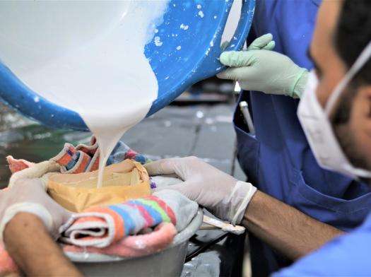 MSF teams in Gaza pour white liquid to make a mould of a prosthetic face for people with facial scars.